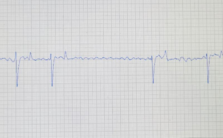 ecg cheval mort subite