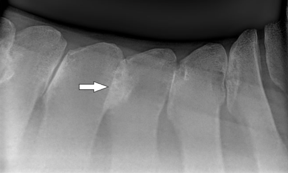 Kissing Spines In Horses: How To Detect Them With Data?